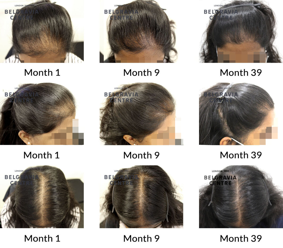 female pattern hair loss the belgravia centre 266293