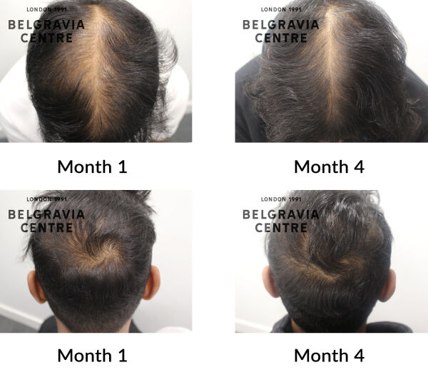 male pattern hair loss the belgravia centre 442212
