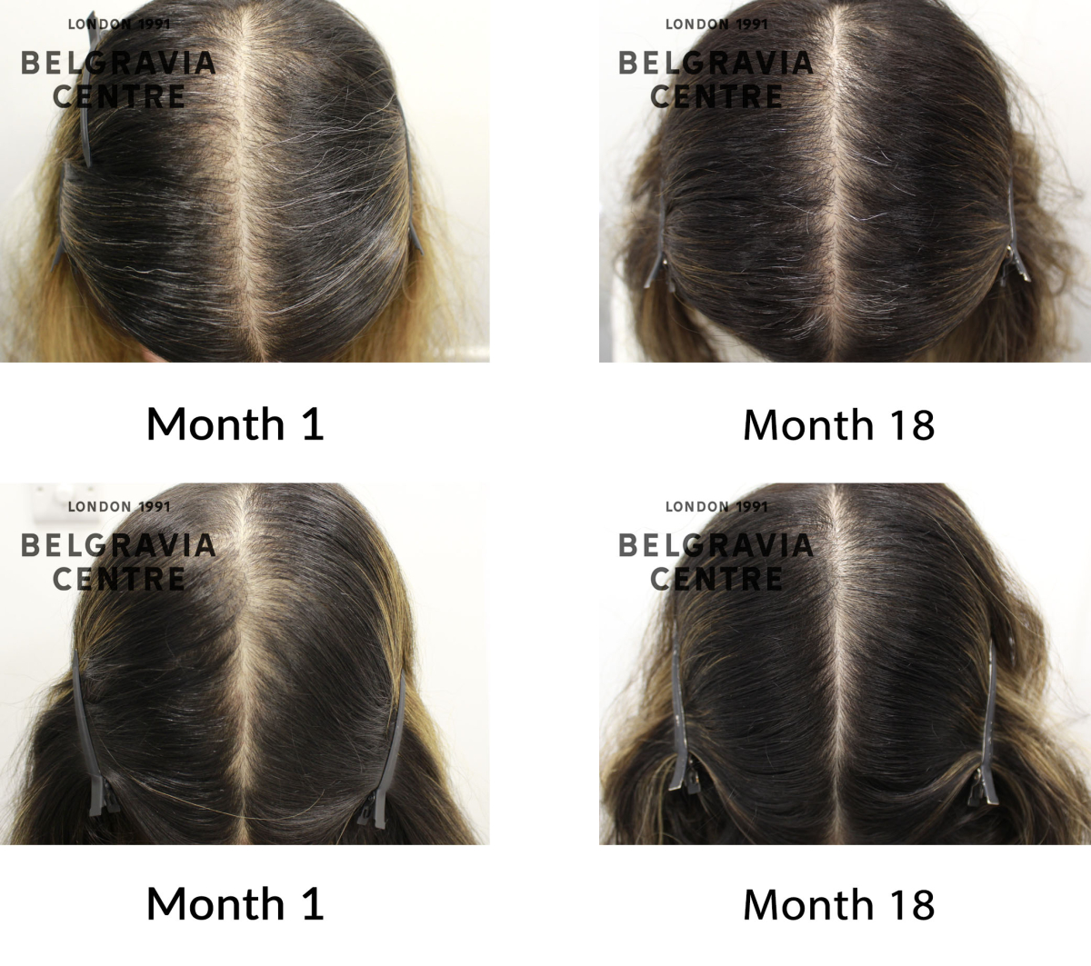 female pattern hair loss the belgravia centre 422063
