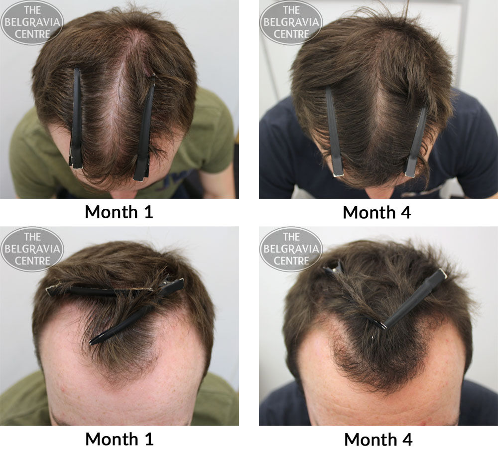 male pattern hair loss the belgravia centre ma 28 09