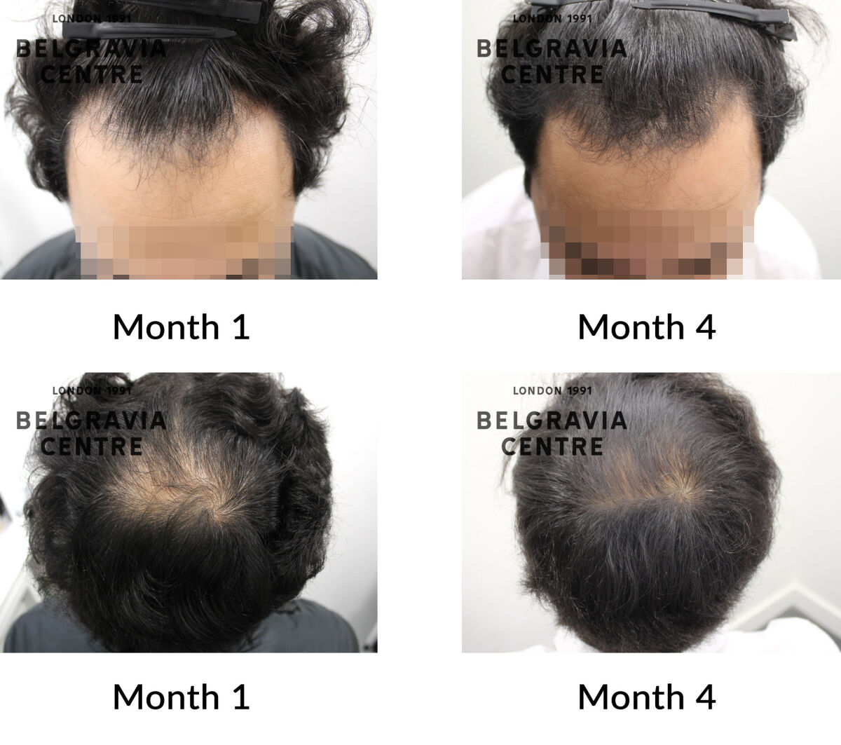 male pattern hair loss the belgravia centre 440962
