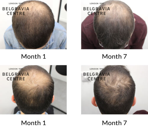 male pattern hair loss the belgravia centre 425652
