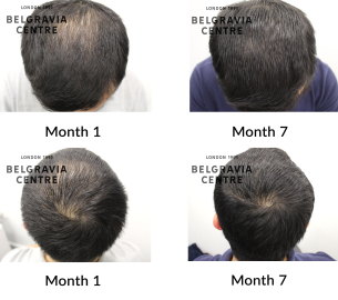 male pattern hair loss the belgravia centre 454817
