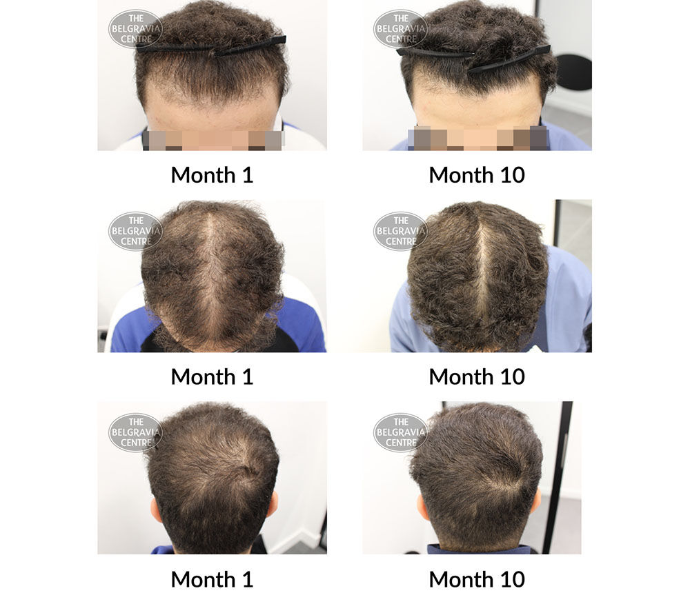 male pattern hair loss the belgravia centre 405199 27 05 2021