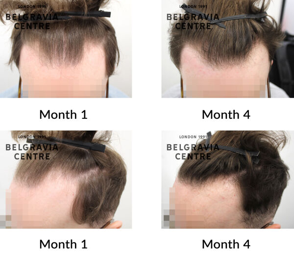 male pattern hair loss the belgravia centre 440793
