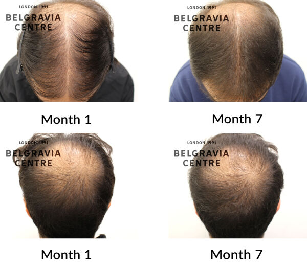 male pattern hair loss the belgravia centre 448114