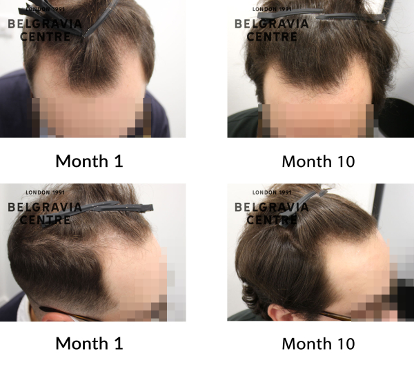 male pattern hair loss the belgravia centre 429671