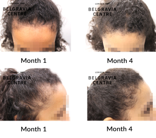 diffuse hair Loss and female pattern hair loss 458986