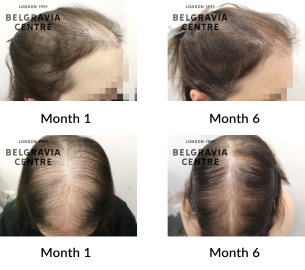 female pattern hair loss and diffuse thinning the belgravia centre 435475