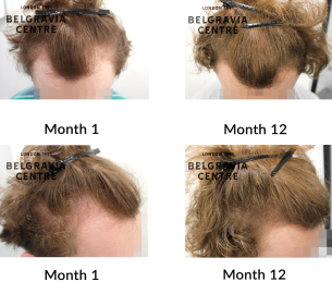 male pattern hair loss the belgravia centre 453805