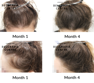 female pattern hair loss and telogen effluvium chronic the belgravia centre 466198