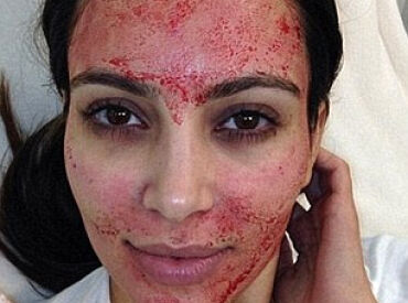 Kim Kardashian Vampire Blood Facial Used to Combat Baldness The Belgravia Centre Hair Loss Blog
