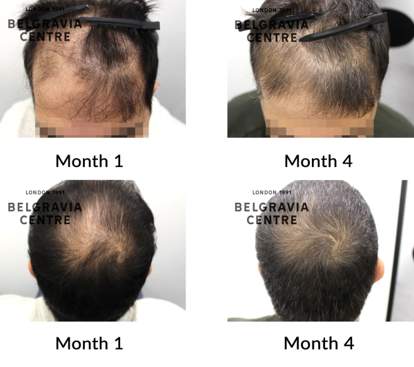 male pattern hair loss the belgravia centre 451425