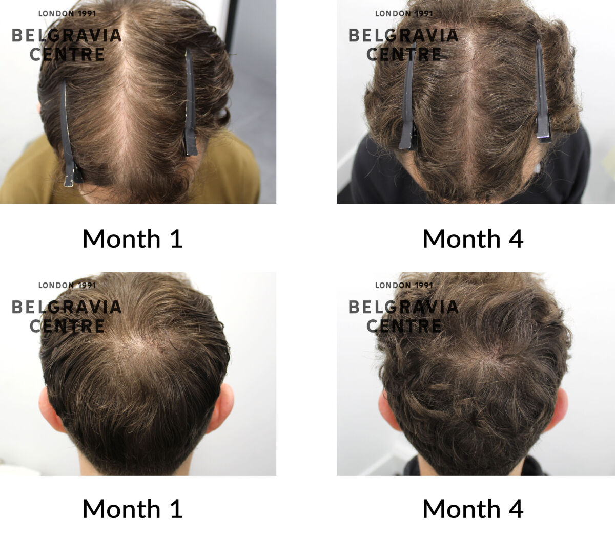 male pattern hair loss the belgravia centre 436985