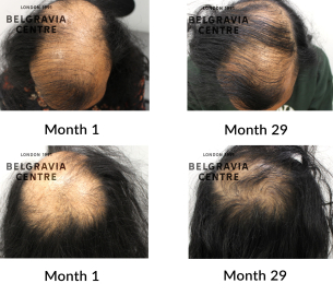male pattern hair loss the belgravia centre 424888