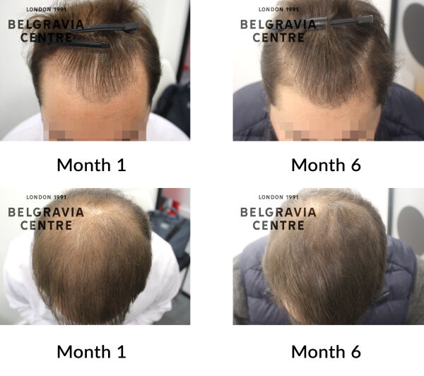 male pattern hair loss the belgravia centre 444223