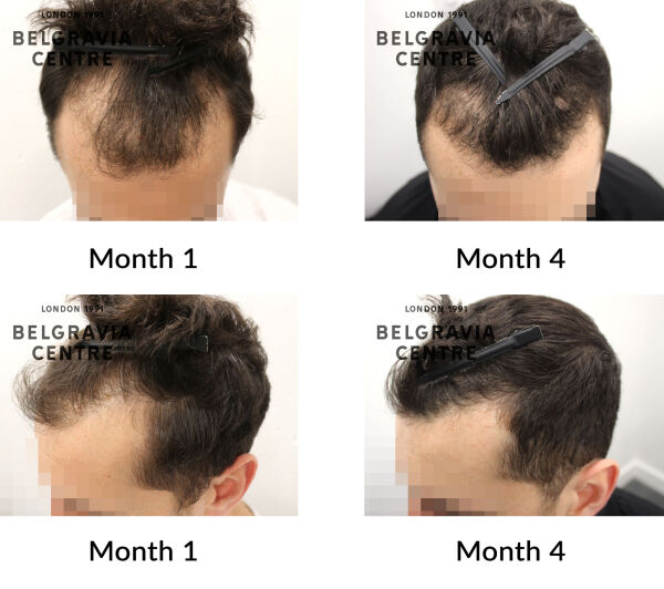 male pattern hair loss the belgravia centre 447624