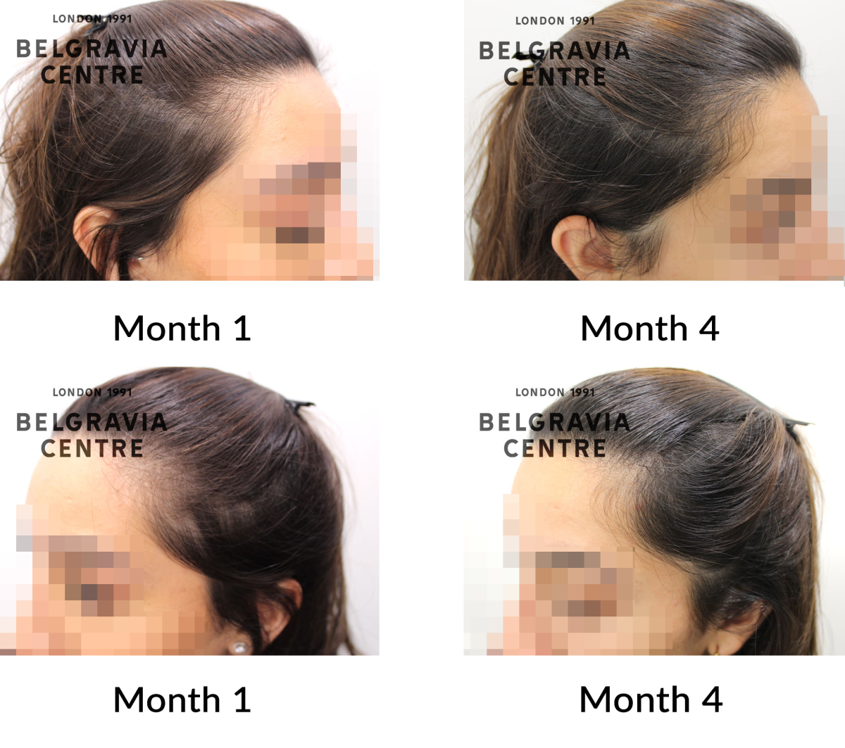 female pattern hair loss the belgravia centre 455567