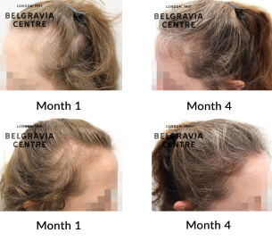 female pattern hair loss the belgravia centre 459681