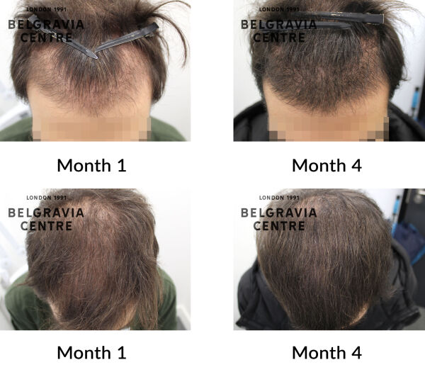 male pattern hair loss the belgravia centre 443861