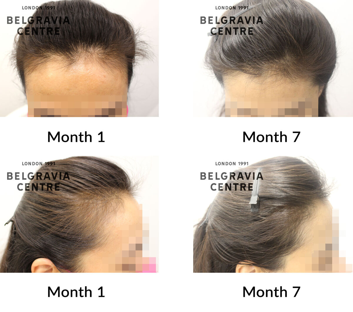 female pattern hair loss the belgravia centre 160762