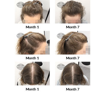 alert female pattern hair loss the belgravia centre 408630 10 05 2021 2