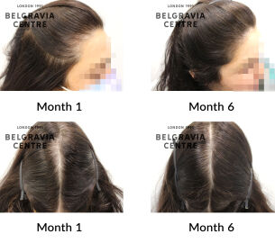 female pattern hair loss the belgravia centre 430711