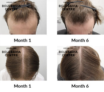 alert male pattern hair loss the belgravia centre 426875 1