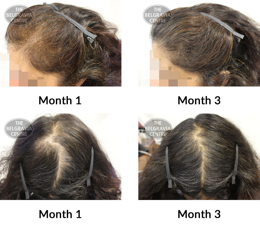 female pattern hair loss the belgravia centre 351622 08 07 2019