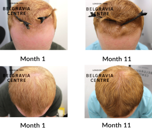 male pattern hair loss the belgravia centre 448756