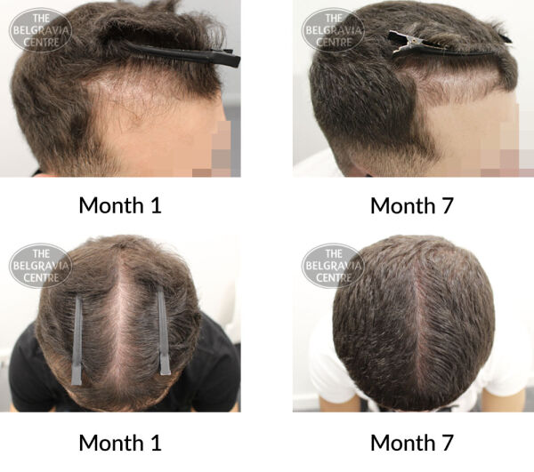 male pattern hair loss the belgravia centre 390688 17 09 2020