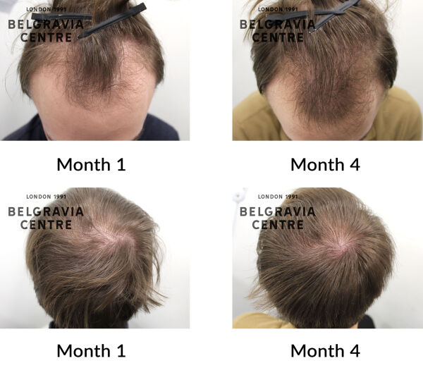 male pattern hair loss the belgravia centre 450551