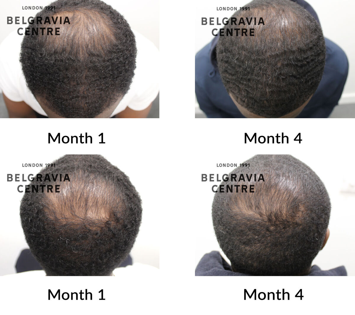 male pattern hair loss the belgravia centre 451208