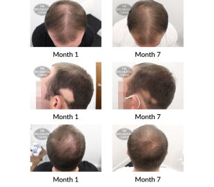 alopecia areata and male pattern hair loss the belgravia centre 397957 25 09 2020