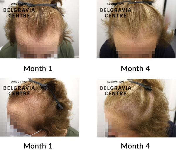 female pattern hair loss the belgravia centre 436813