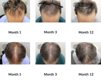 male pattern hair loss the belgravia centre 368192 03 09 2019