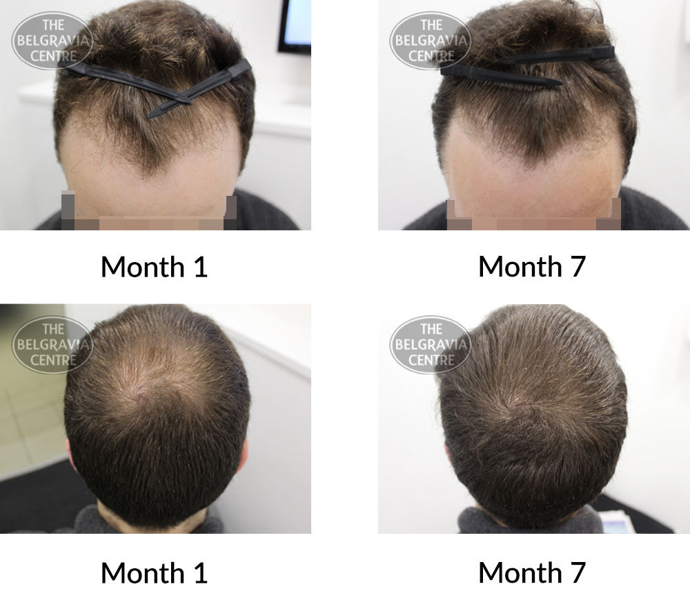 male pattern hair loss the belgravia centre 394981 22 07 2020