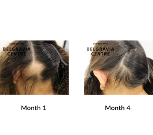 alopecia areata and female pattern hair loss the belgravia centre 437938