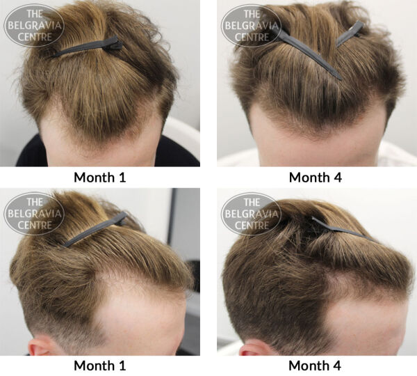 male pattern hair loss the belgravia centre FG 05 02 2019