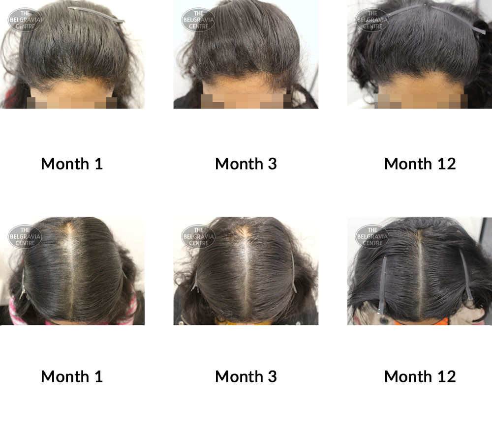 female pattern hair loss the belgravia centre 349709 04 11 2019