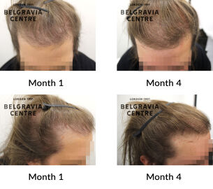 female pattern hair loss the belgravia centre 440082