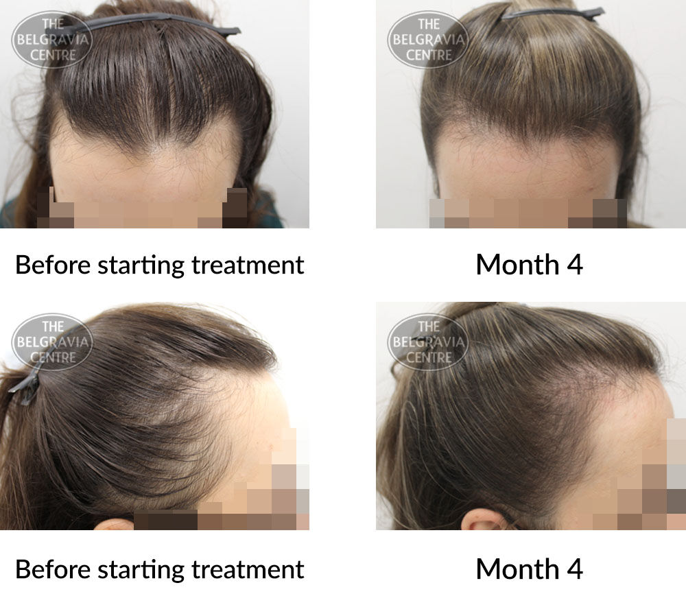 female pattern hair loss and diffuse hair loss the belgravia centre 395925 24 09 2020