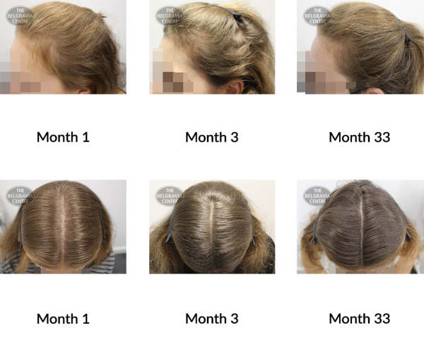 female pattern hair loss and telogen effluvium the belgravia centre 370423 17 06 2021