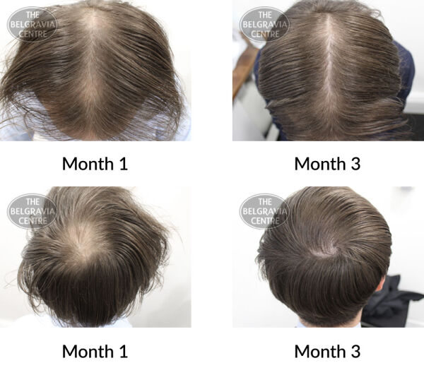 male pattern hair loss the belgravia centre 393907 24 08 2020