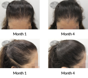 female pattern hair loss the belgravia centre 406779 08 12 2020