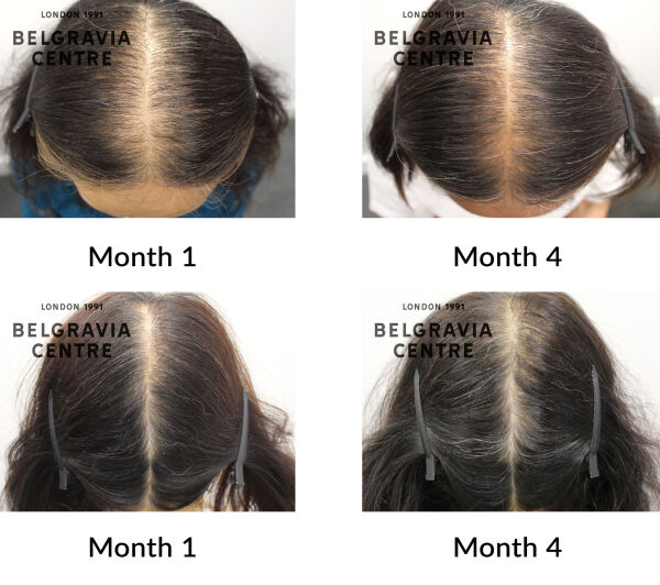 female pattern hair loss the belgravia centre 439540