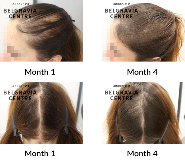 female pattern hair loss the belgravia centre 447765