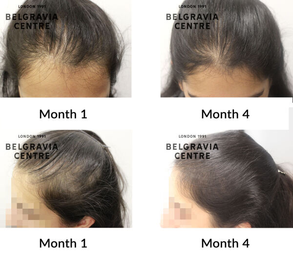 female pattern hair loss the belgravia centre 444291