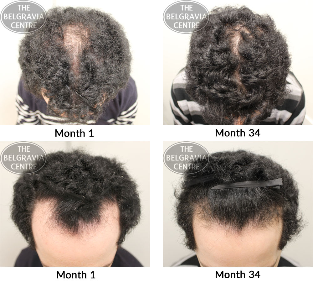 male pattern hair loss the belgravia centre lf 26 03 2018 1