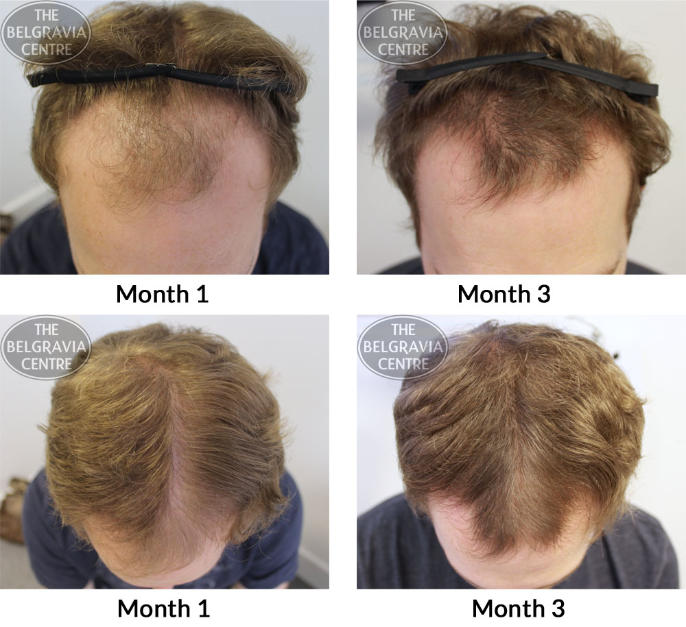 Male Pattern Hair Loss The Belgravia Centre AK 30 10